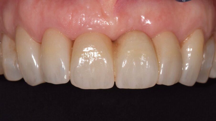 Fig. 9: Fixed dental prostheses in situ at the recall appointment.