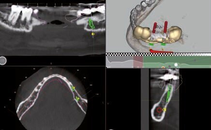 Fig. 6 - Progettazione dima chirurgica.