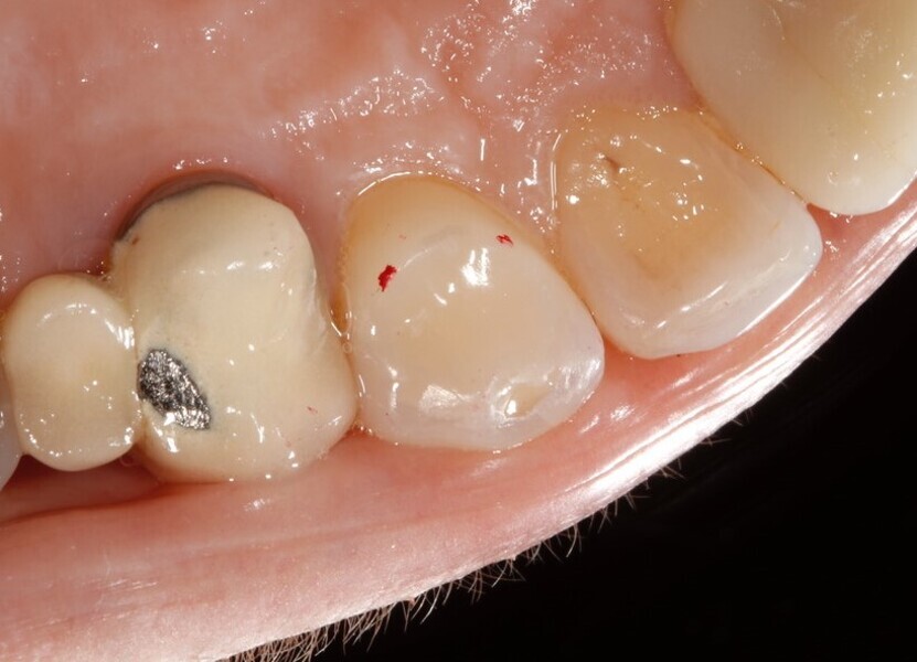 Fig. 11: 2017—palatal platforms placed on the maxillary canines using Venus Diamond (Kulzer).