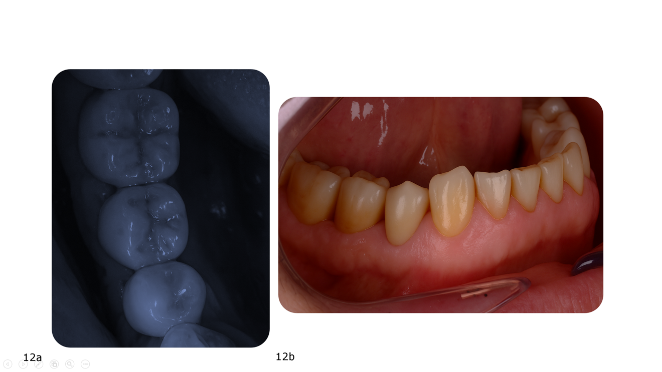 Figs. 12a & b: Six-month follow-up of the 3D-printed hybrid composite restoration, showing the restoration’s aesthetic integration and healthy, stable tissue, occlusal view (a) and buccal view (b).