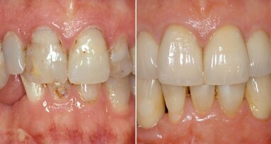 Webinar discusses advanced implant dentistry using digital technology