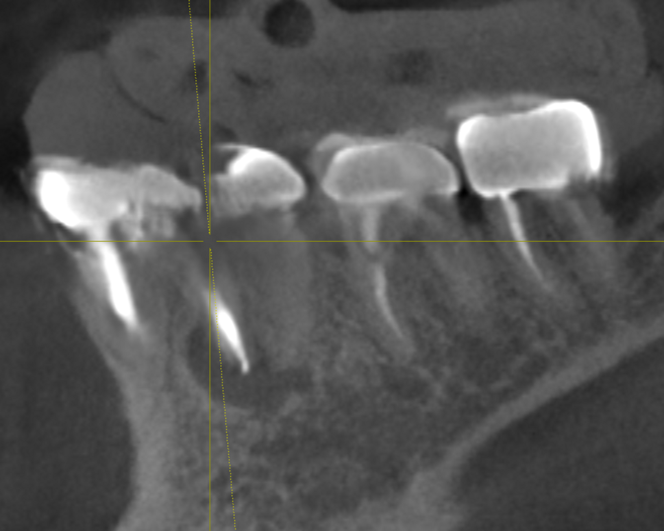 Figs. 2a–c: CBCT scan showing the failing endodontically treated tooth with an abscess.