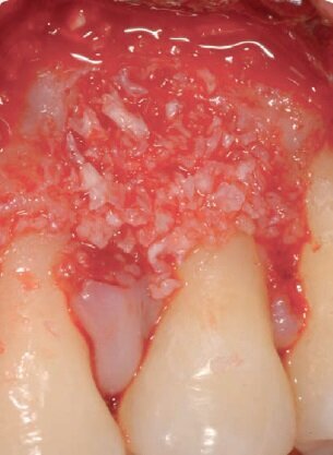 Figg. 7, 8 - Difetto riempito con Biomateriale (Rebone© – UBGEN) e amelogenine (Emdogain).