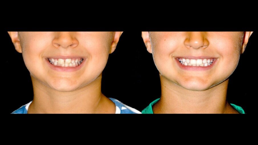 Fig. 10_Confronto pre e post dell’esposizione del sorriso.