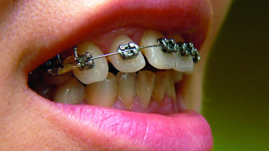 Il ruolo dell’igienista nell’ortodonzia