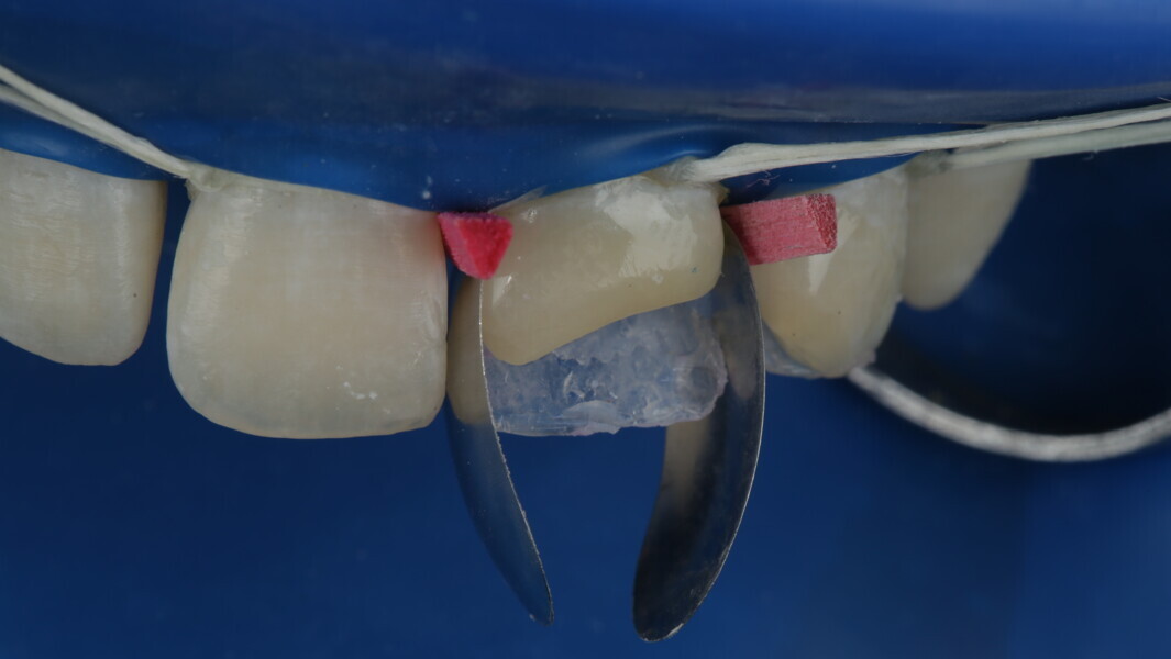 Fig 19 and Fig 20: The sectional matrix for posterior teeth was used in a vertical direction and stabilized with wedge on both mesial and distal side.