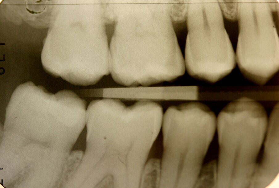 Fig. 3_Bite-wing di destra.