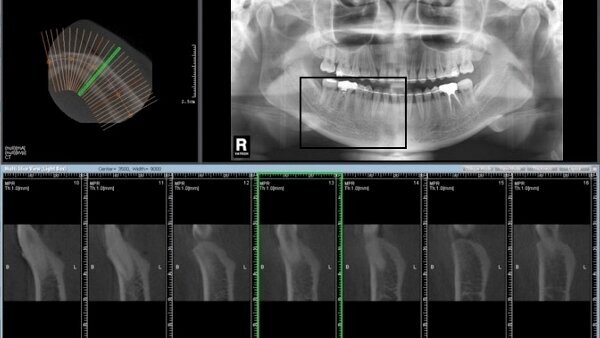 Η παραδοσιακή απεικόνιση δε θα εξαφανιστεί με την εφαρμογή της Υπολογιστικής Τομογραφίας Κωνικής Δέσμης-CBCT