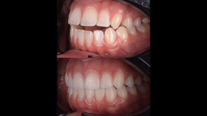 Treating a complex anterior open bite