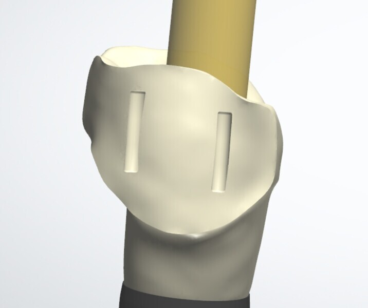 Fig. 7: Abutment design on 3Shape Implant Studio.
