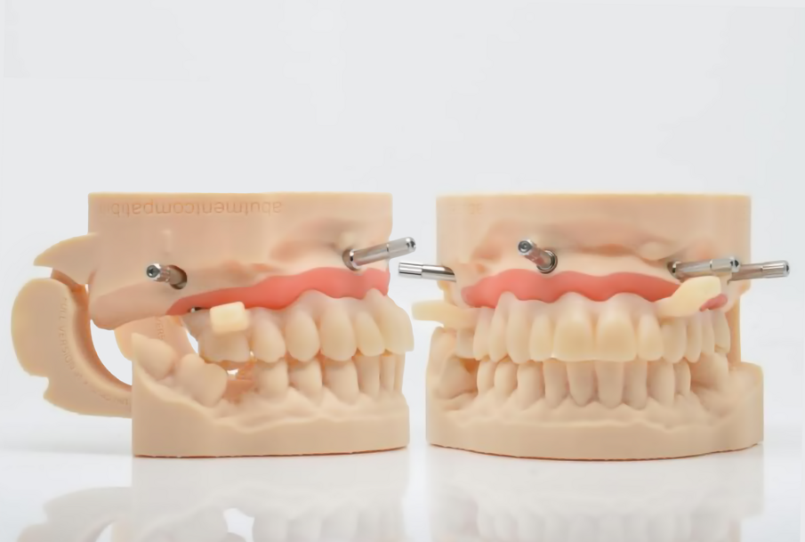 Fig. 1_Un lampante esempio di modello stampato in 3D con parte rosa della gengiva in silicone e struttura protesica per un provvisorio a carico immediato.