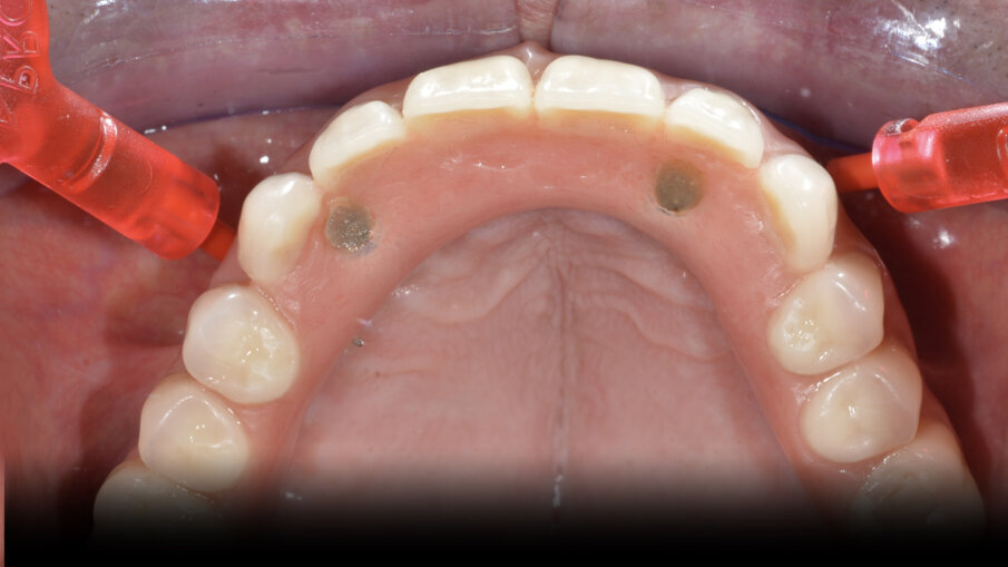 Fig. 18_Scelta e utilizzo degli scovolini.