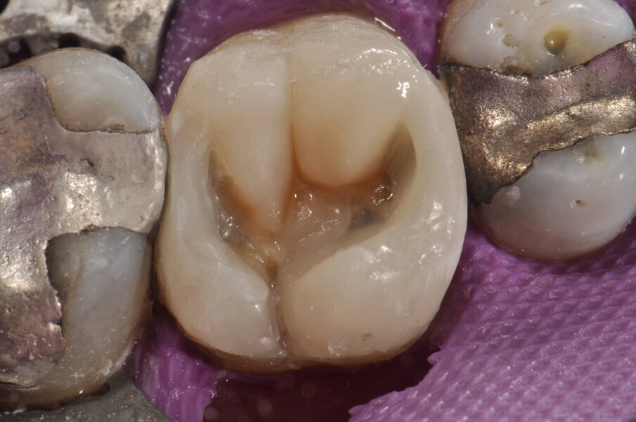 Fig. 9: Acabado de la cúspide mesiobucal y caracterización cromática del sistema de fisuras.