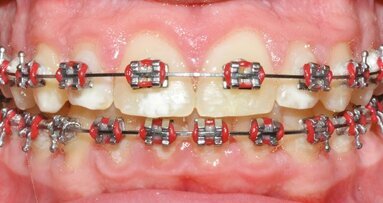 Protocollo sperimentale per la gestione dei tessuti duri durante il trattamento ortodontico