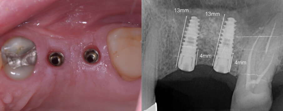 Fig. 7 - Condizionamento dei tessuti molli ed endorale di controllo.