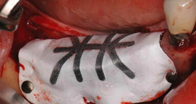 Predicibilità chirurgica della rigenerazione ossea verticale (GBR) nella mandibola posteriore edentula: disegno, gestione e passivazione dei tessuti molli come chiavi principali di successo