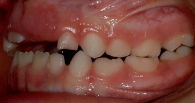 Lasery w stomatologii dziecięcej - perspektywa kliniczna