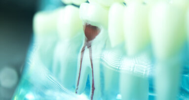 The access cavity in endodontics: Three rules for a predictable outcome in complex cases