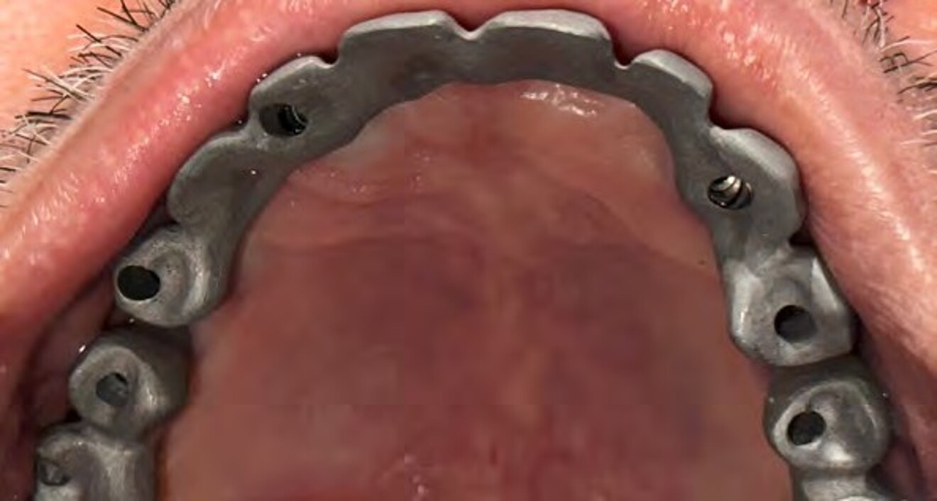 Fig.  2d: Maxillary metal framework try-in to verify passive fit and adaptation prior to definitive prosthesis fabrication.