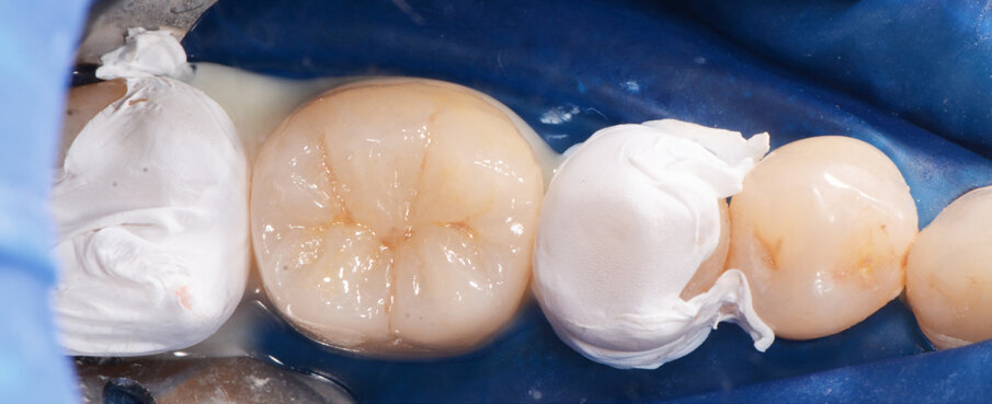 Fig. 8: Placing the crown