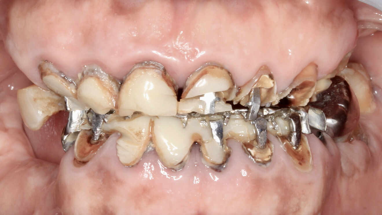 Fig. 1b: Intra-oral frontal view with the teeth in maximum intercuspation, showing extensive tooth wear and multiple failing restorations.
