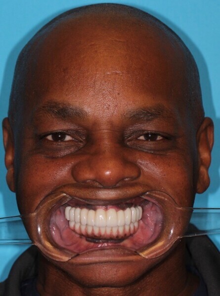 Fig. 38: Full-face retracted view of the completed case.