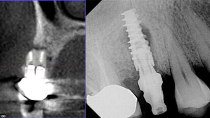 Avoiding the pitfalls of implants with 3-D imaging