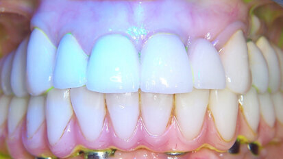 Utilizzo della terapia fotodinamica Helbo nel trattamento delle perimplantiti: case report