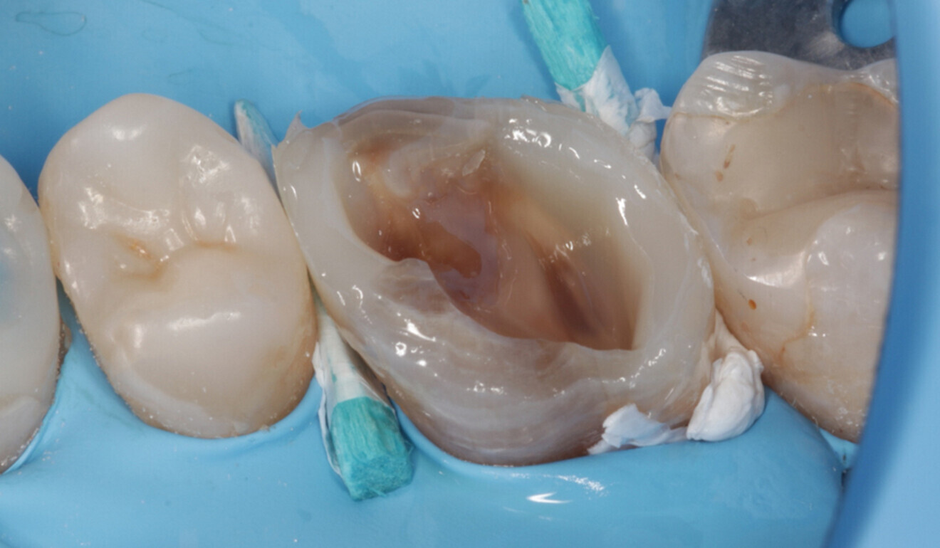 Fig. 13: Proximal walls build-up, palatal view. (Image: Kuraray Noritake Dental)