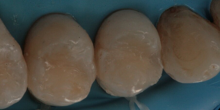 Figg. 17, 18_Restauri delle cavità.