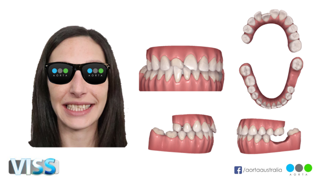 Fig. 33: Patient’s facial photograph to be considered in the treatment plan, alongside the Invisalign software simulation.
