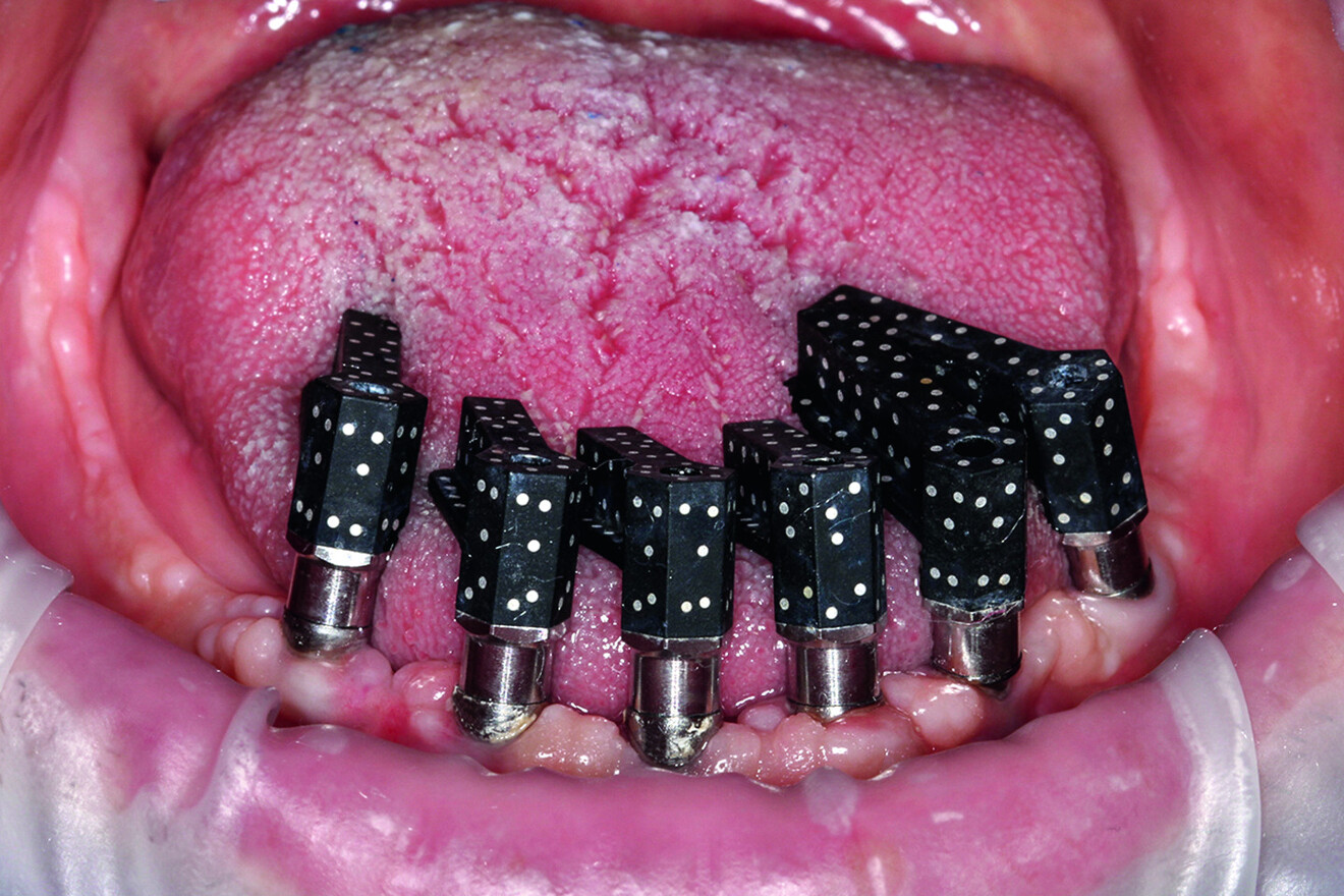 Fig. 3 : Des piliers de scan codés spécialement conçus sont utilisés pour transférer avec précision les positions implantaires au prothésiste dentaire, via une photogrammétrie intra-orale de pointe pour cette arcade mandibulaire.
