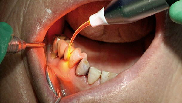 Parodontale Erhaltungstherapie völlig schmerzfrei und delegierbar