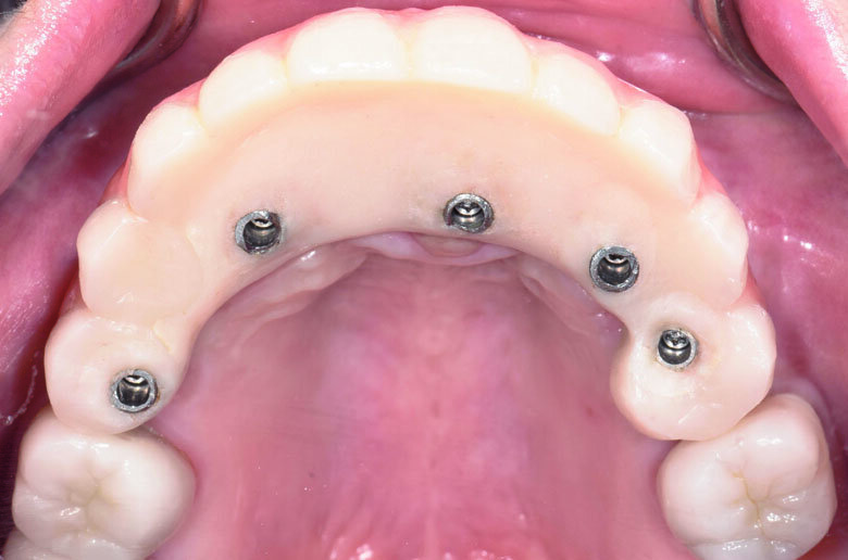 Fig 23. Post-operative occlusal view