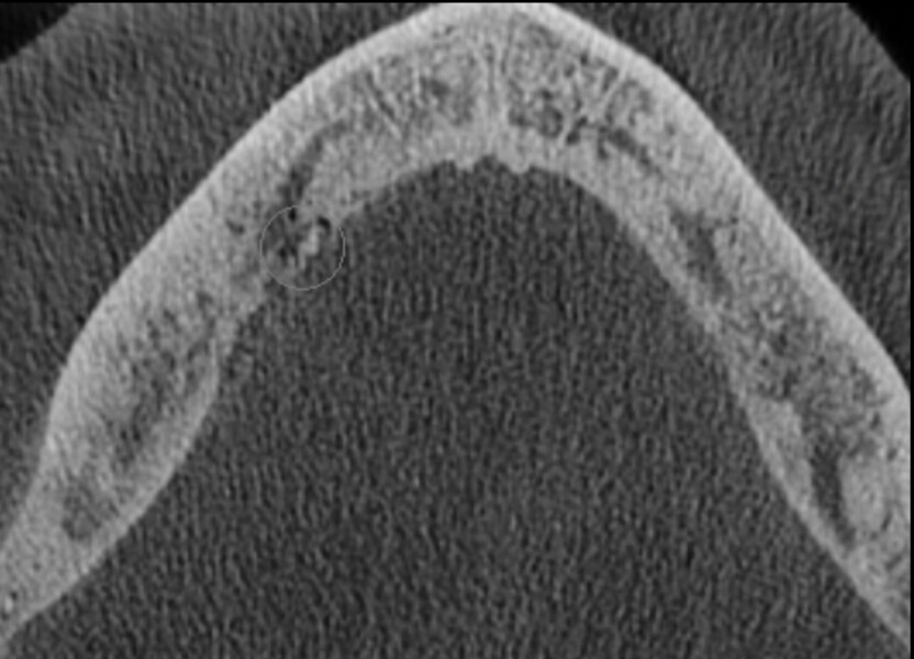 Figs. 11a–e: Axial and coronal views of the CBCT scan showing the quality of the bone in this typical bisphosphonate-associated bone necrosis case.