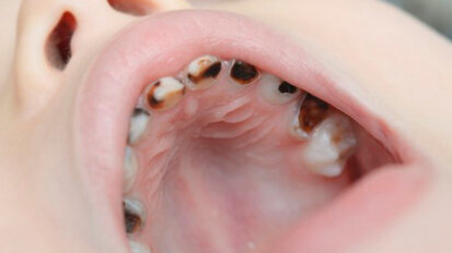 Il rischio di carie potrebbe non attenuarsi nemmeno a seguito di cure preventive