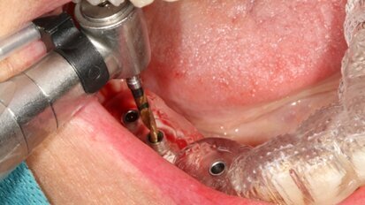 Pourquoi avoir recours à un guide chirurgical pour placer un implant ?