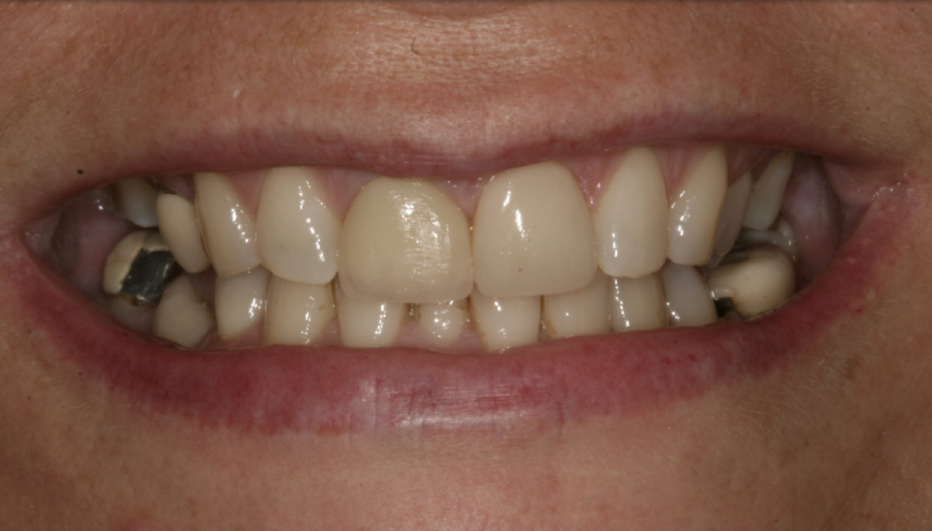 Fig. 2: 2004—reduced anterior guidance.