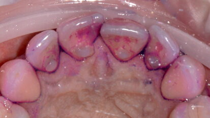 Applicazione del protocollo GBT nel trattamento di un caso di gengivite