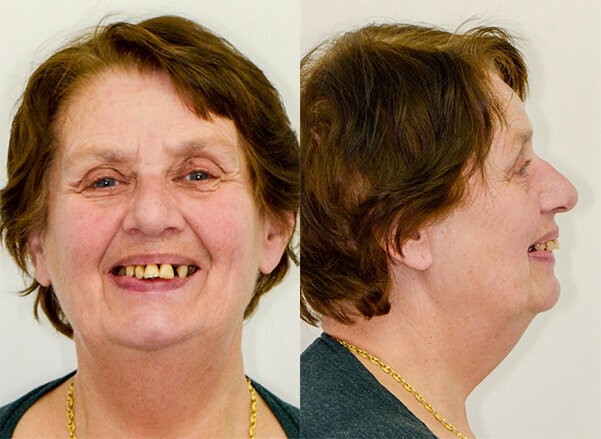 Figs: 1 and 2: Preoperative situation.  The aesthetic and functional shortcomings are clearly visible on the baseline pictures.