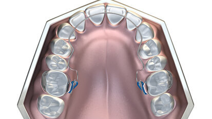 How to avoid extractions when treating malocclusions using MRC’s Bent Wire System (BWS) and Trainer System for arch development How to avoid extractions when treating malocclusions using MRC’s Bent Wire System (BWS) and Trainer System for arch development