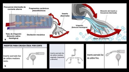 Piezocirugía  (4). Principios generales de la tecnología piezoeléctrica