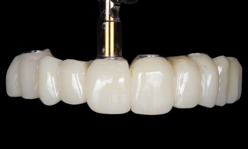 Figs. 63–66: The provisional restoration was secured to the temporary abutments.