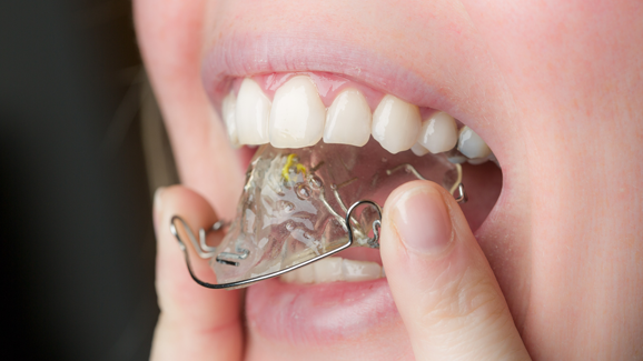 Nickel in Zahnspangen: Selten Allergieauslöser