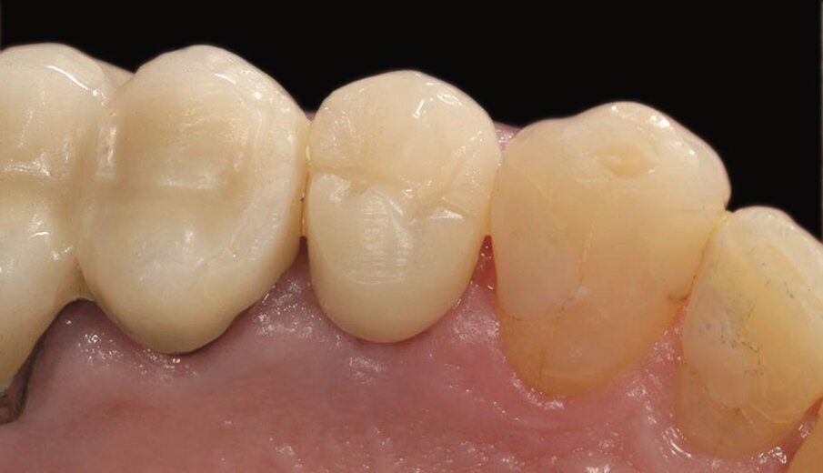 Fig. 2c_Fase protesica provvisoria libera da contatti occlusali.