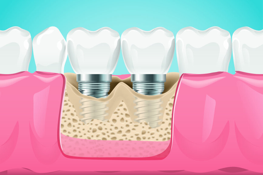 Fig. 2 : PA2c : Perte osseuse < 60 % de la hauteur implantaire, défaut de 1 à 4 parois avec cratère > 3 mm sur les deux implants.