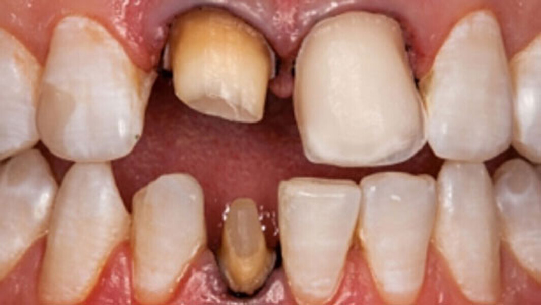 Fig. 3. Tras la preparación se colocaron hilos de retracción para optimizar el registro óptico.