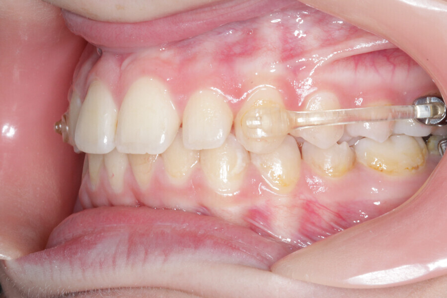 Fig. 10: Accomplishment of a Class I platform after three months of Motion. Case ready to scan and submit to Reveal.