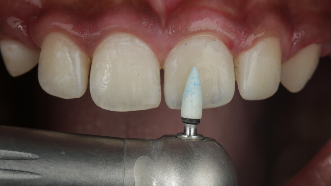 Fig 36: The secondary anatomy was obtained using Shofu white finishing stone to create undulation often referred to as the “Eiffel Tower”. It is always important to evaluate the depth and the extension in the neighboring tooth so as not to exaggerate its presence.