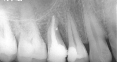 The DownPak device: Obturation with heat and vibration